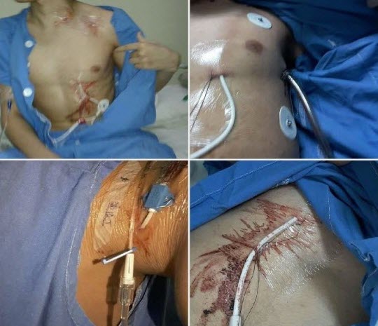 Leucemia Linaje Mixto