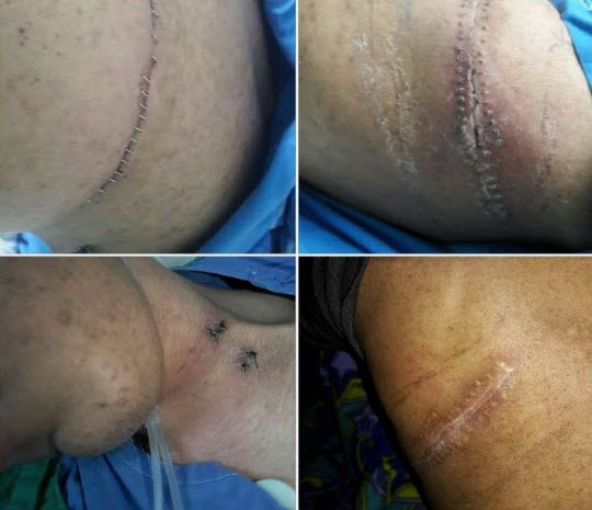 Leucemia Linaje Mixto